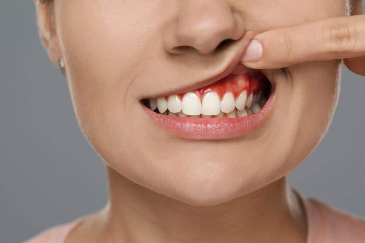 Woman with inflamed gums showing signs of periodontal disease affecting upper teeth.