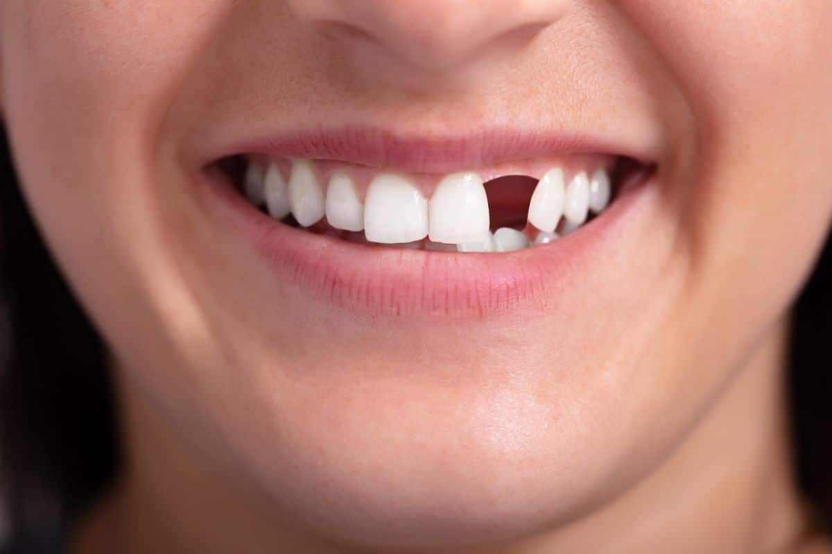 Lose a Front Tooth Close-up of a patient's smile showing a missing front tooth gap requiring dental restoration.