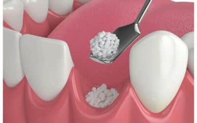 Do You Need a Bone Graft Before Getting Dental Implants?