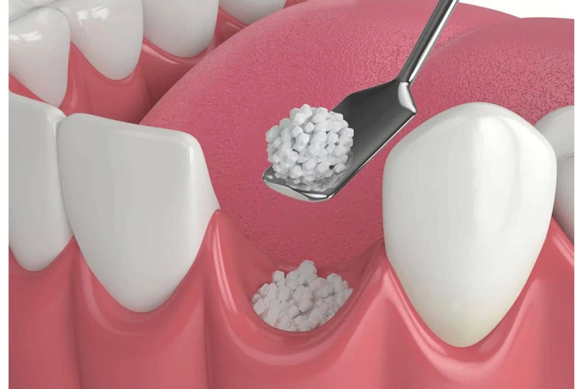 Dental illustration showing bone graft material being placed between teeth for implant preparation.