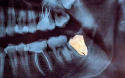 How Can You Make My Tooth Extraction Heal Faster?