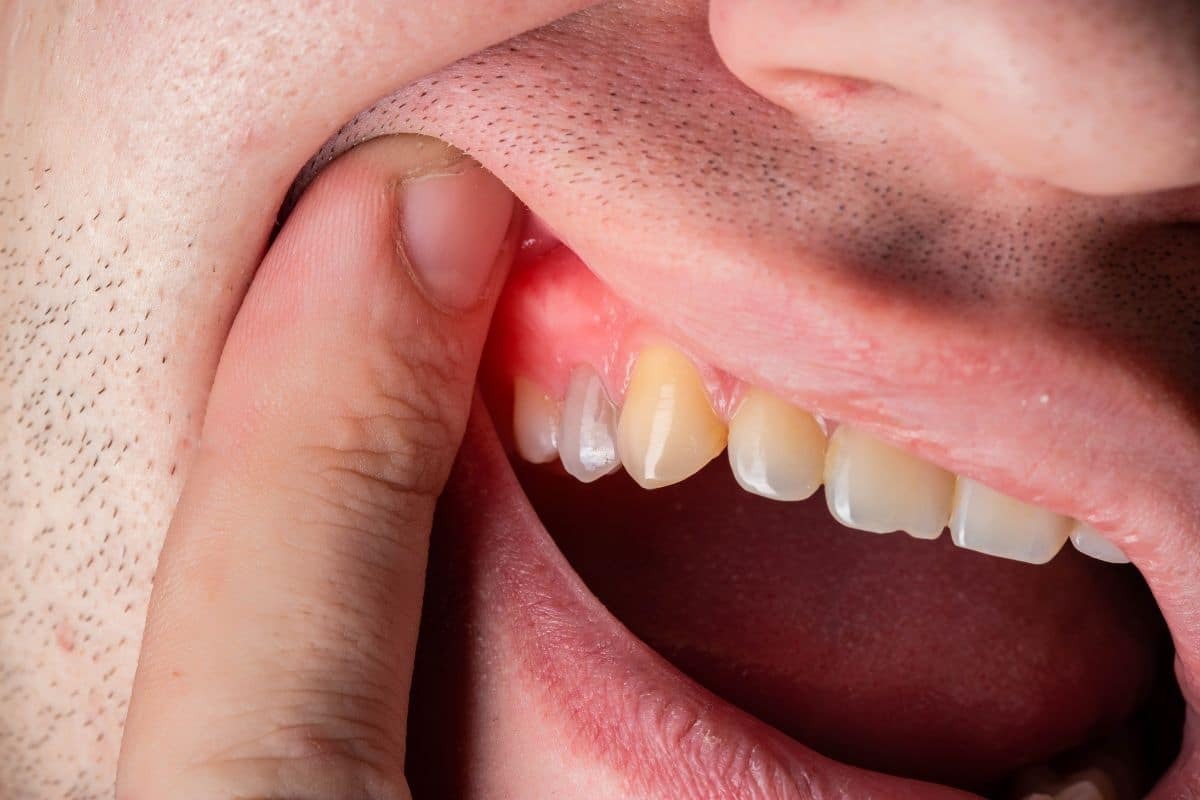 How Gum Disease Affects More Than Just Your Mouth Close-up of inflamed gum tissue showing redness and swelling above upper teeth.