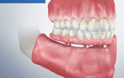 What to Expect After Surgery: Recovery with Fixed Hybrid Dentures