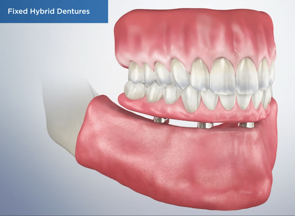 Fixed hybrid denture with artificial teeth secured to pink gum-colored base showing dental implant attachments.