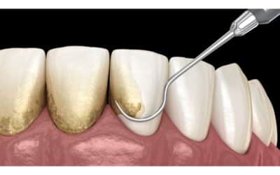 How Often Do You Need Scaling and Root Planing for Healthy Gums?