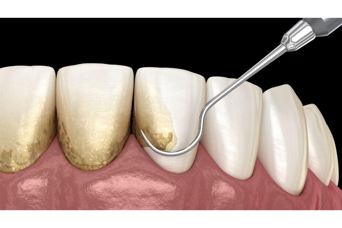 How Often Do You Need Scaling and Root Planing for Healthy Gums Dental scaling and root planing procedure showing tartar removal from tooth surface with ultrasonic scaler.