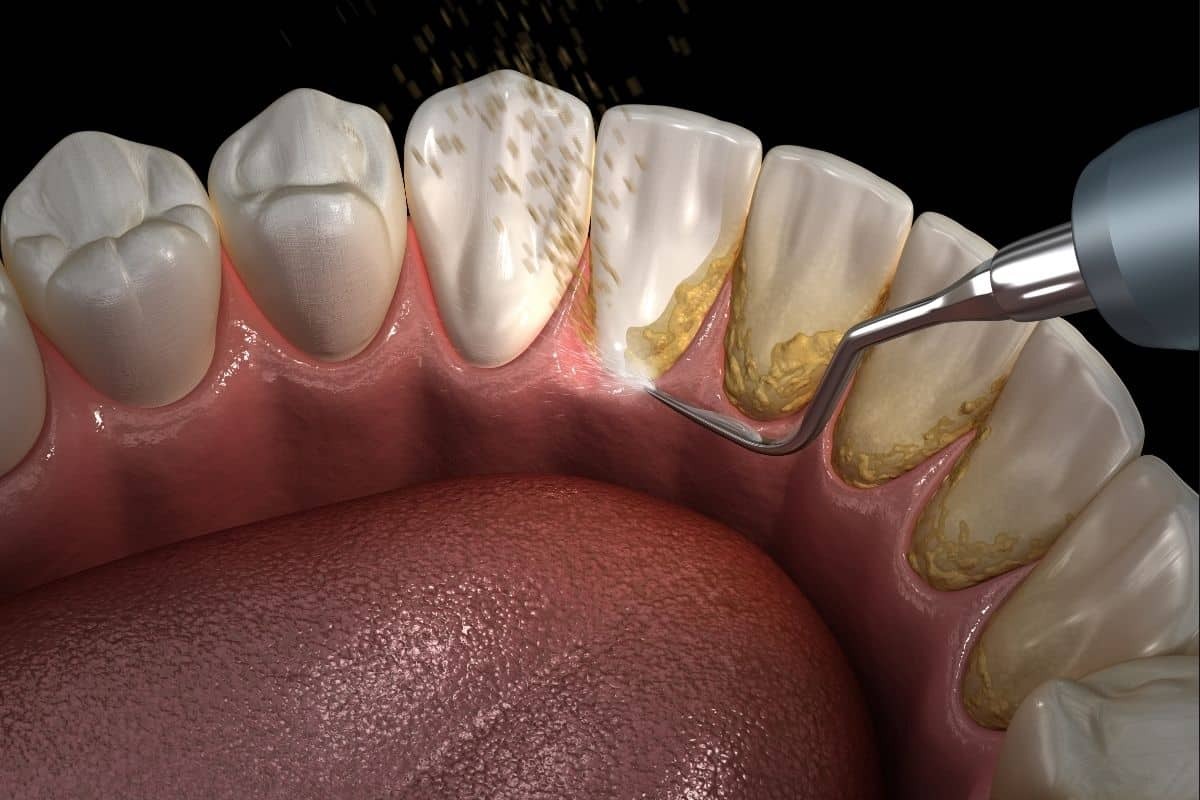 Plaque and Calculus Buildup 3D dental illustration showing tartar and plaque buildup on teeth requiring professional cleaning.