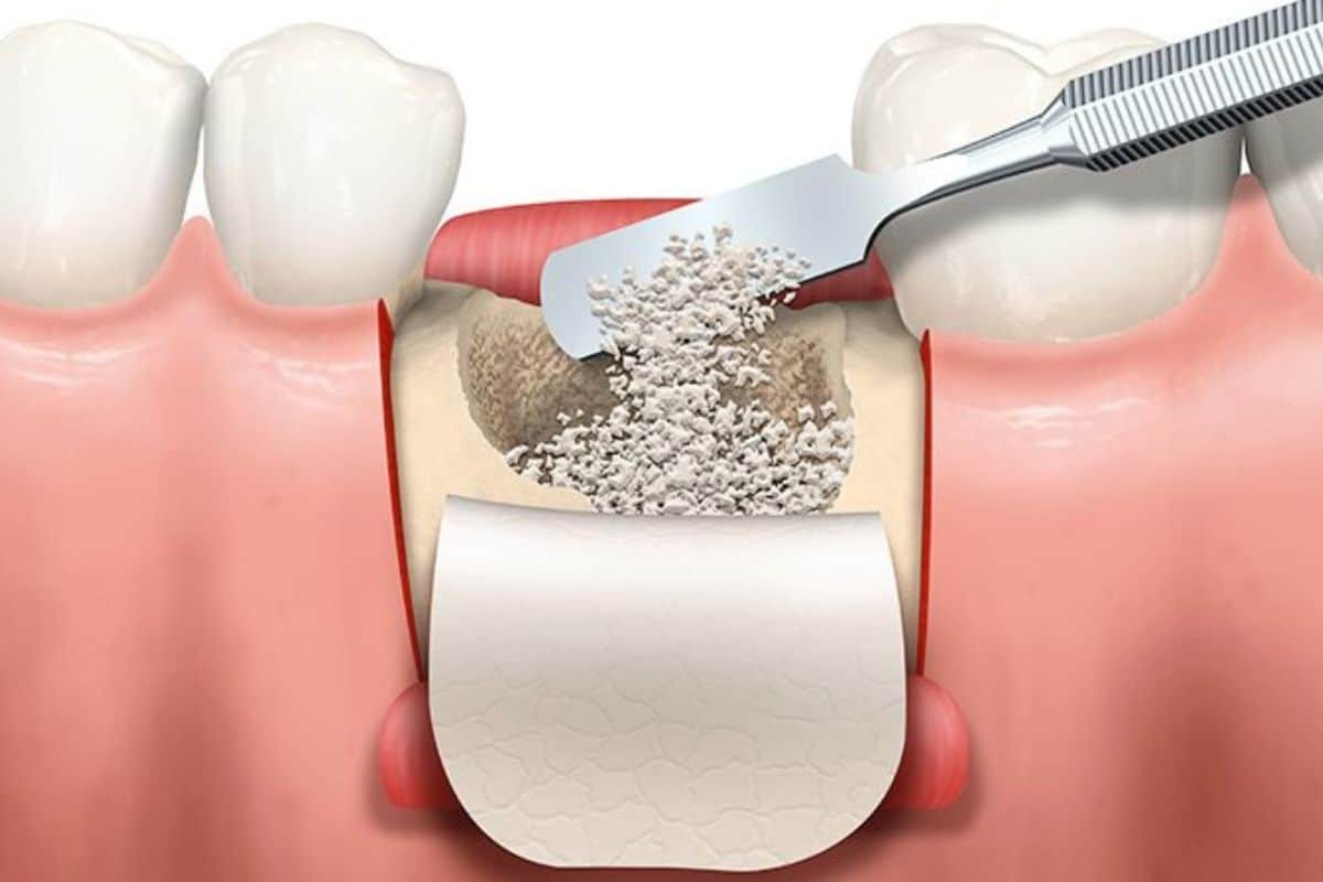 Bone graft material being placed into extraction socket during dental implant preparation procedure.