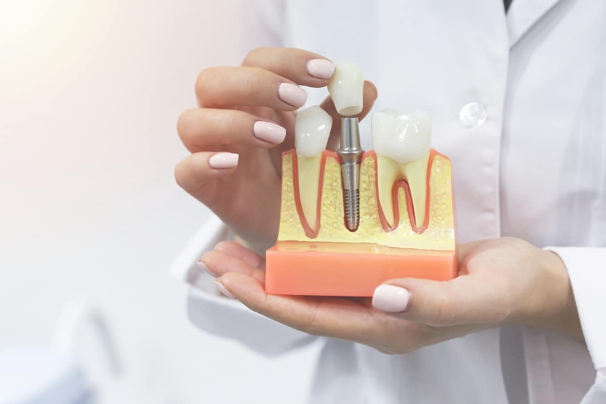 Book Your Consultation for Anterior Implants and Healing Cap Placement Dentist holding dental Implant model showing tooth replacement with healing cap and bone structure.