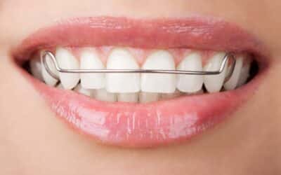 Temporary Essix Retainers After Tooth Extraction or Implant Prep: A Simple Guide