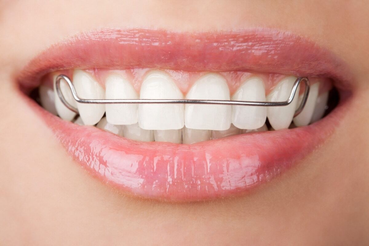 Temporary Essix Retainers After Tooth Extraction or Implant Prep Close-up of bright white teeth with a metal orthodontic wire, demonstrating proper alignment and retention.