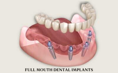Top Benefits of Choosing Removable Full Arch Implant Options for Missing Teeth