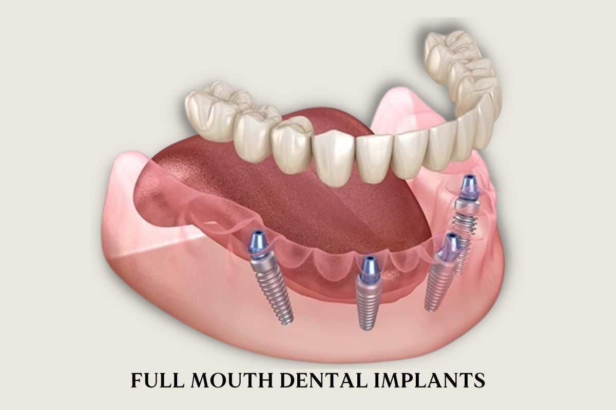 Full mouth dental implants diagram showing four titanium implants supporting a complete arch of replacement teeth.