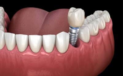 The Role of Bone Grafting in Long-Lasting Dental Implants