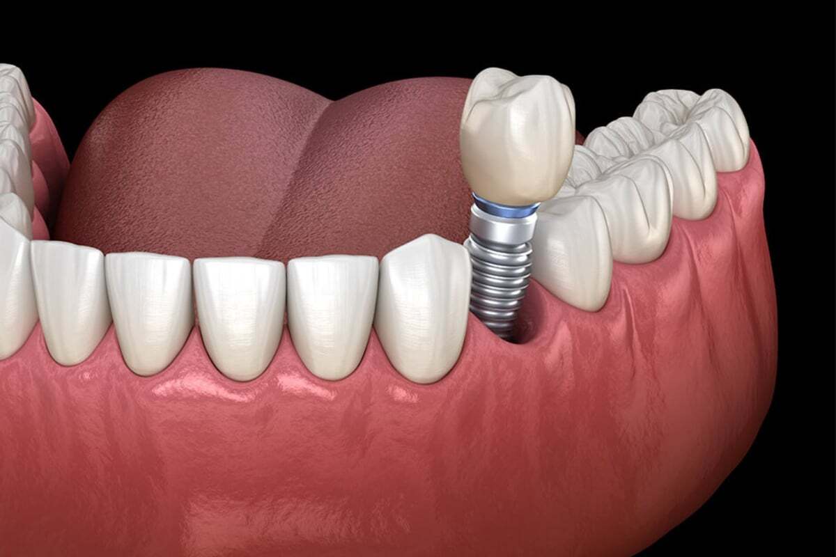 3D dental implant illustration showing bone graft integration with natural teeth and implant crown in Phoenix.