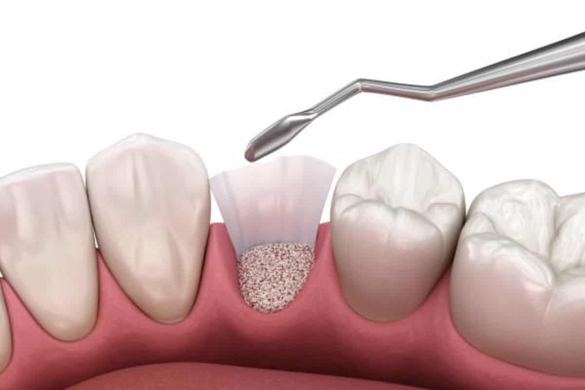 Bone Grafting Recovery What Patients Can Expect Dental bone graft procedure showing grafting material being applied to tooth socket for implant preparation.
