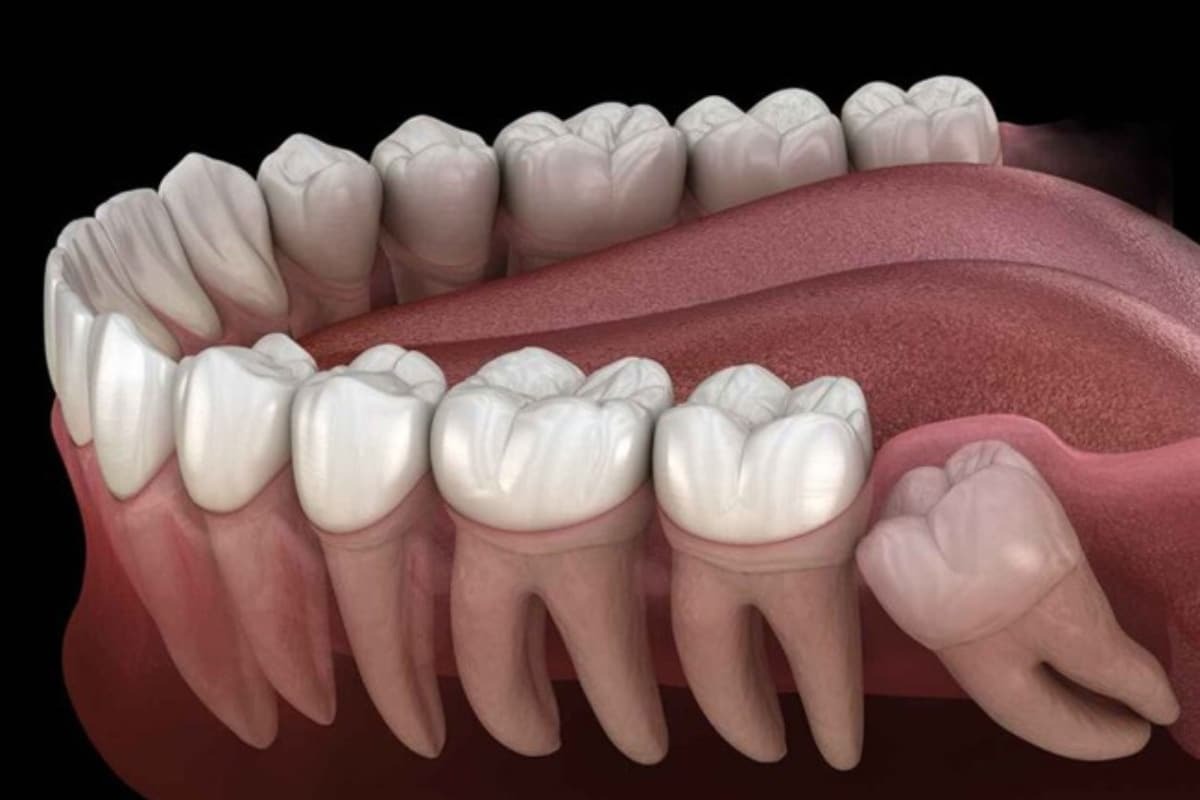 3D illustration of upper and lower teeth showing wisdom tooth extraction anatomy.