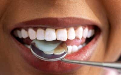 How Teeth-in-a-Day Implants Transform Smiles and Boost Confidence
