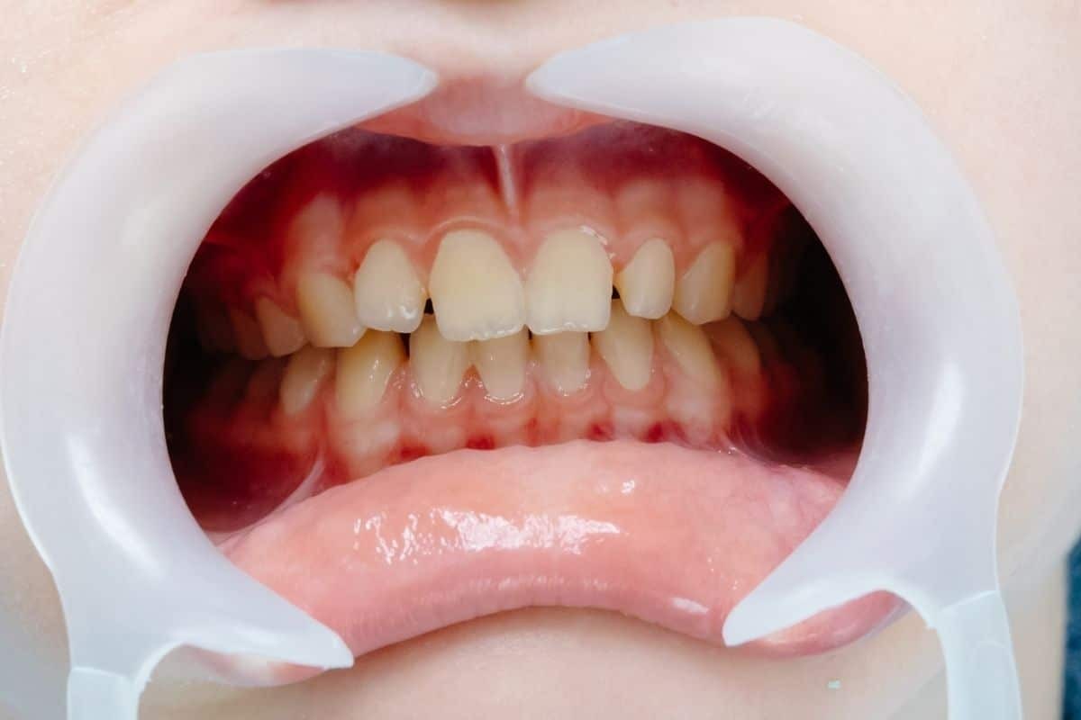 _Gum Regeneration How LANAP and Pinhole Techniques Are Changing Dentistry Close-up of patient's smile showing healthy gums and natural teeth after gum regeneration treatment.