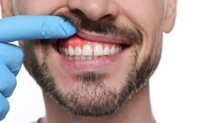 Laser vs. Pinhole: Modern Gum Recession and Gum Disease Treatments Compared