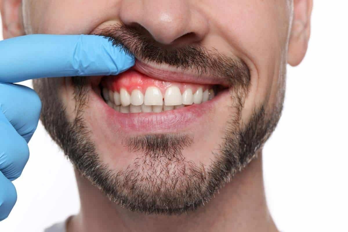 Laser vs. Pinhole Modern Gum Recession and Gum Disease Treatments Compared Male patient displaying healthy gums and white teeth during dental examination with gloved hand.