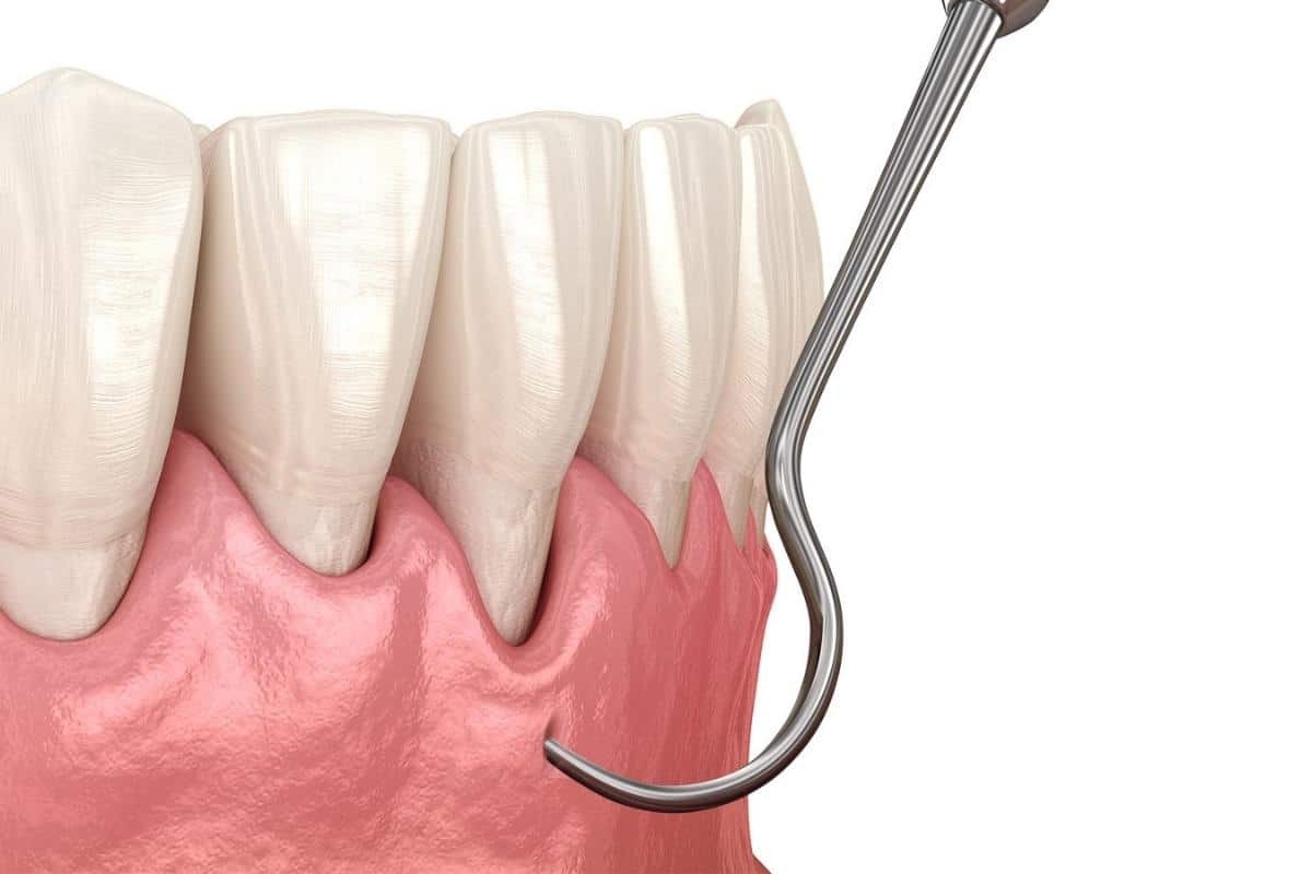 Pinhole surgical technique illustration showing gum recession treatment on front teeth.