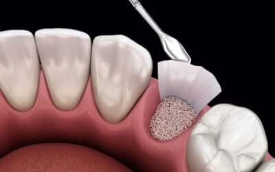 How to Prevent Gum Recession Naturally (and When to See a Specialist)
