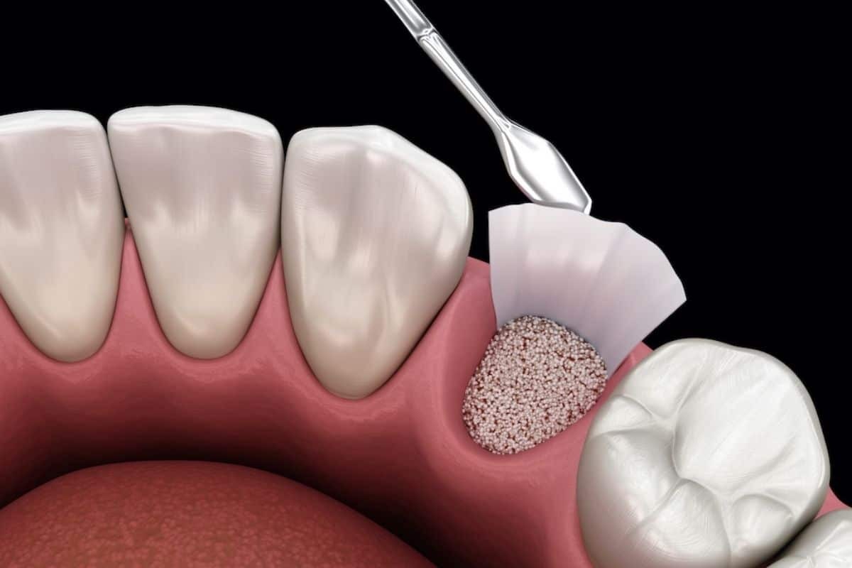 Prevent Gum Recession Naturally & Know When to Visit a Dentist Dental illustration showing bone graft material being applied to treat gum recession between teeth.