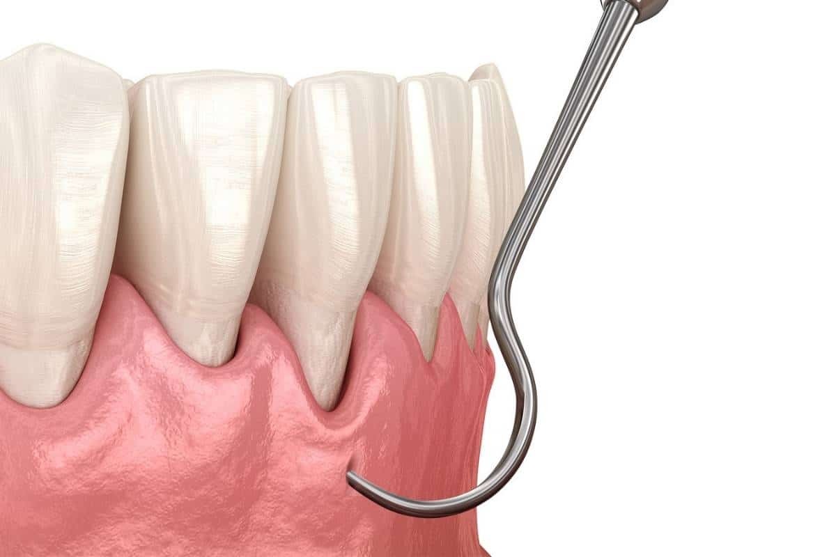 Pinhole gum rejuvenation procedure showing gum tissue being treated with dental instrument.