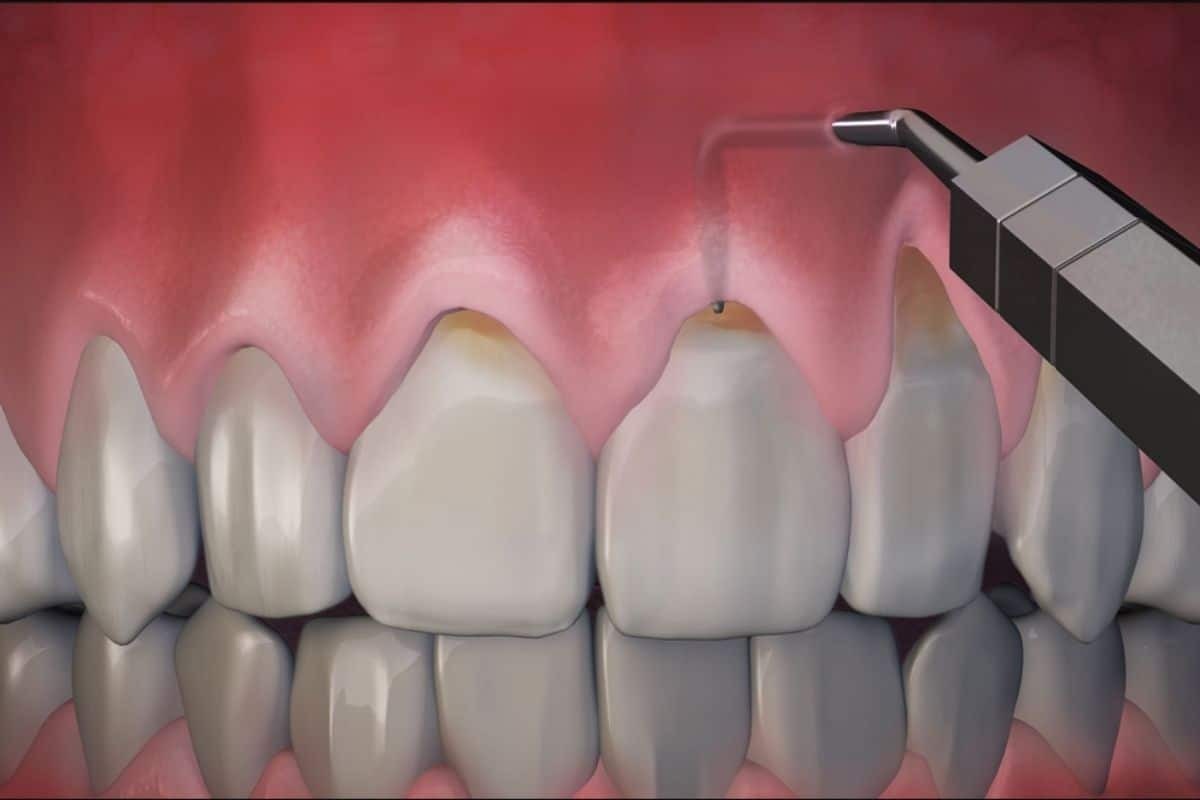 Pinhole gum surgery animation showing gum recession treatment on front teeth with dental instrument.