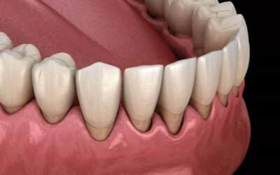 Preventing Gum Disease Relapse: How Periodontal Recall Care Protects Your Smile