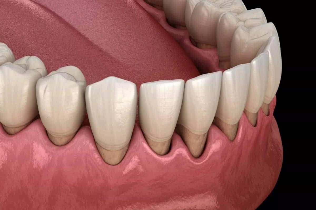 Stop Gum Disease from Returning Expert Periodontal Recall in Phoenix 3D dental illustration showing healthy front teeth and gum tissue after periodontal care treatment.