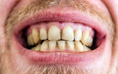 Why Does Plaque Build Up Even After I Brush and Floss?