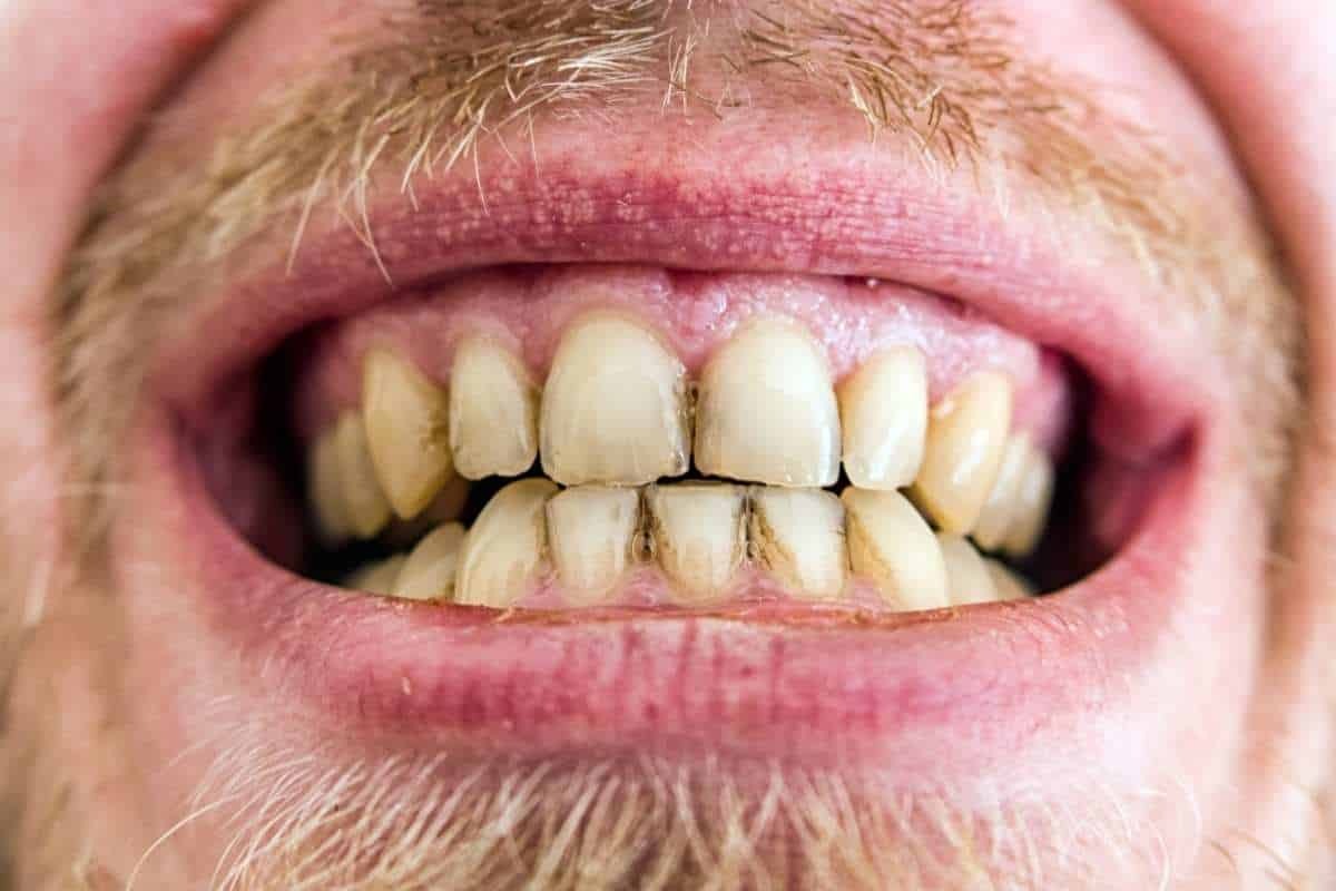 Why Plaque Builds Up After Brushing–Phoenix Periodontist Tips Close-up of yellowed and stained teeth with visible plaque buildup despite brushing and flossing efforts.