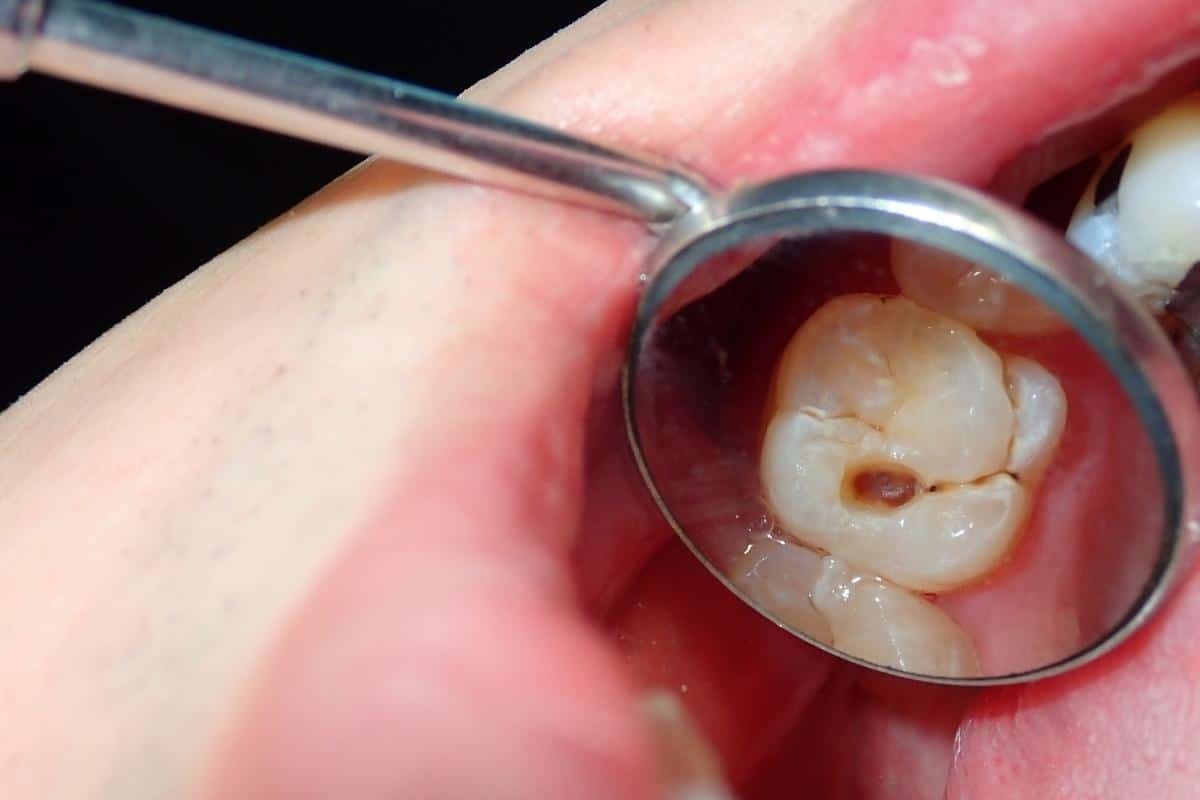 Dental mirror showing tooth decay and cavity examination during patient checkup.