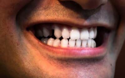 Dental Replacement Options Explained: Implants, Bridges, or Dentures – Which Is Right for You?