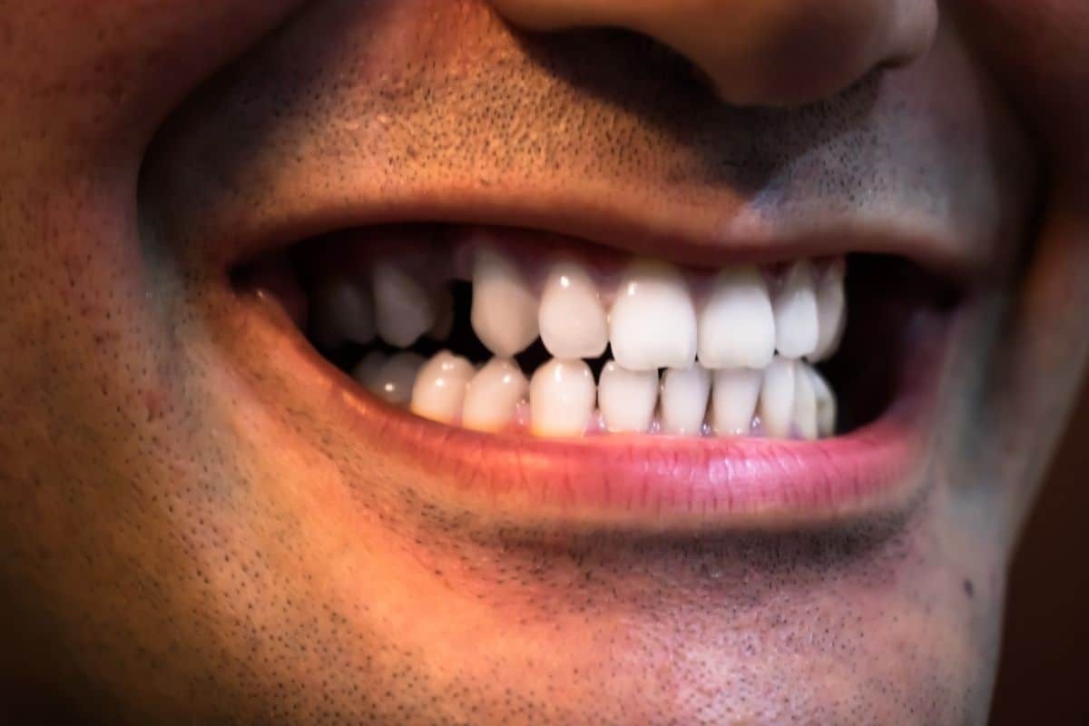 Replacing Missing Teeth Close-up of a bright white smile showing healthy upper and lower teeth with pink gums.