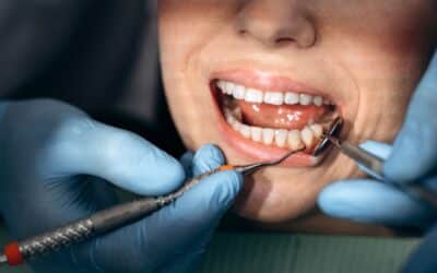 What Happens If You Wait Too Long for a Gum Graft? Our Dentist Explains