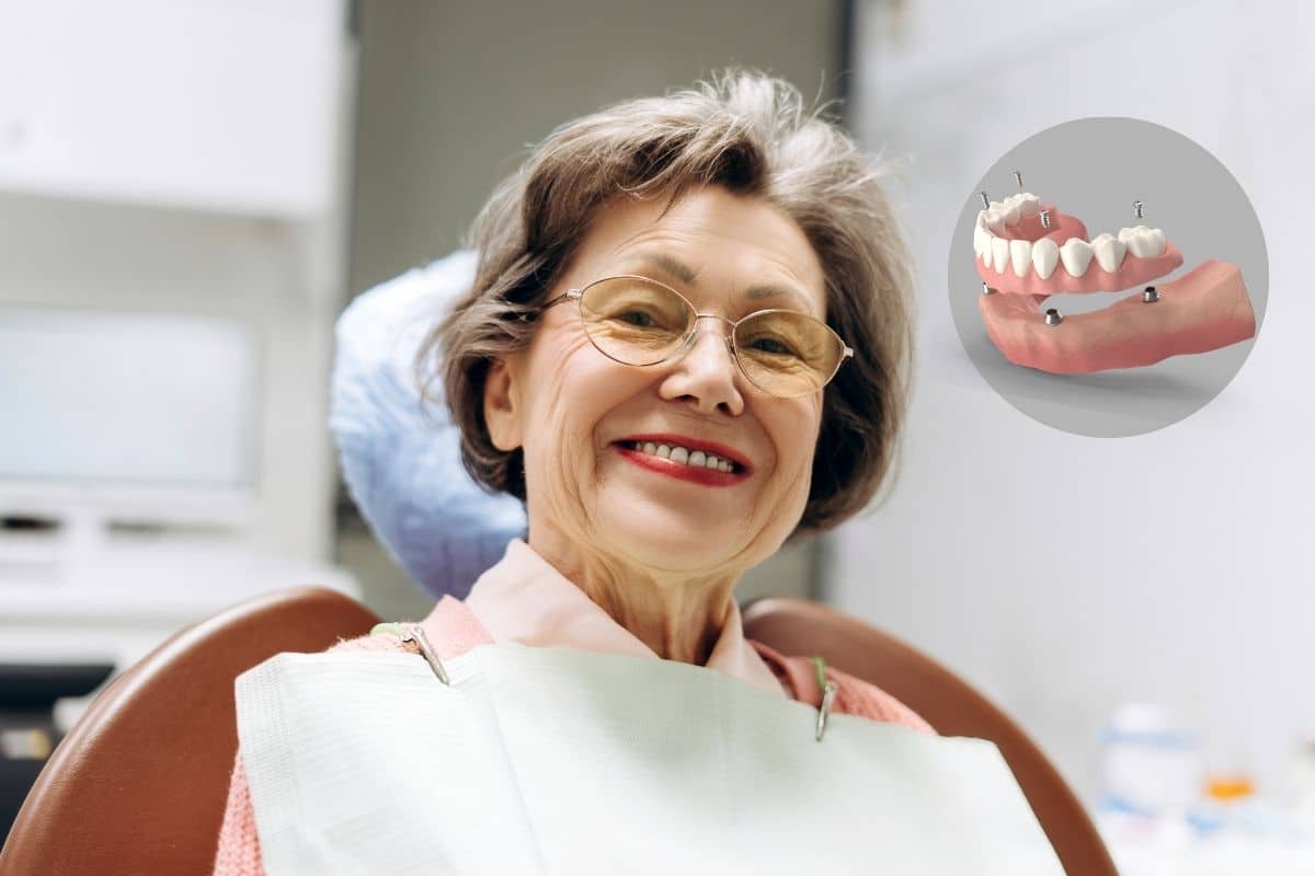 Full Arch Implants Recovery Timeline