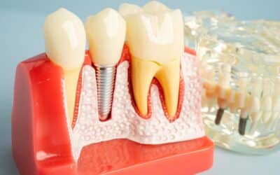 Can You Get Dental Implants If You Have TMJ or Bruxism?