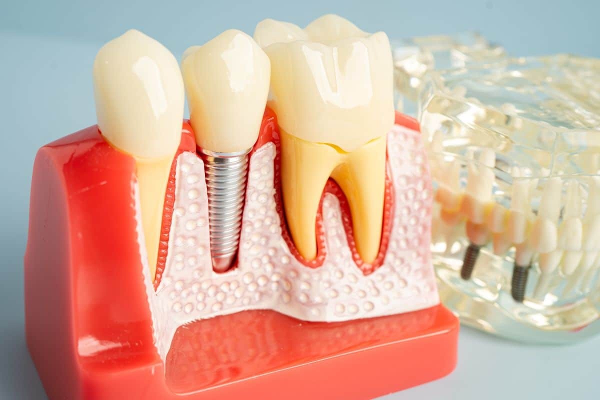 Dental implant model showing natural tooth, implant with screw, and tooth with root canal on gum tissue.