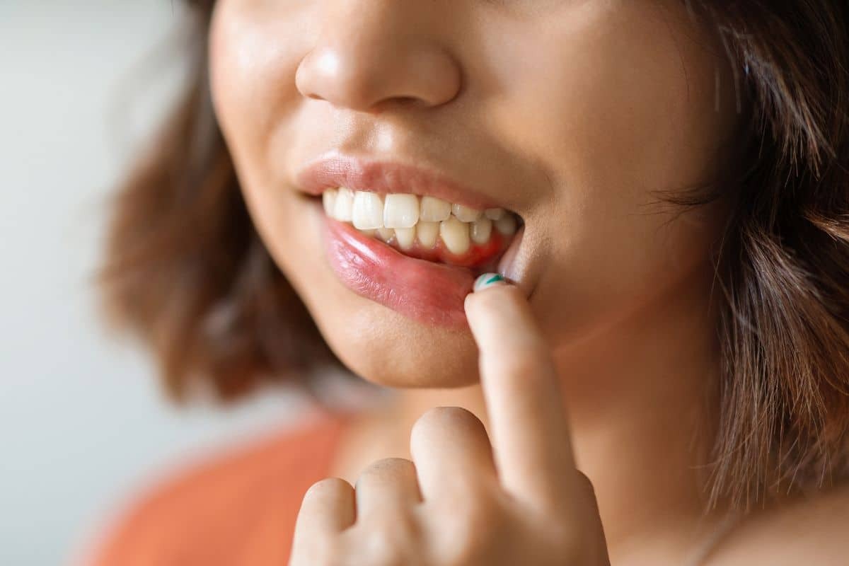 Woman with gum disease showing red, inflamed gums and tooth discoloration requiring dental treatment.